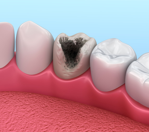 Marietta Problems with Tooth Pulp